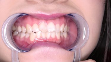 激オススメ女優 須崎美羽チャンの激レア歯口内観察＆涎垂らし電マ当て！